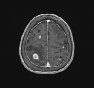 뇌전이암metastatic brain tumor : 네이버 블로그