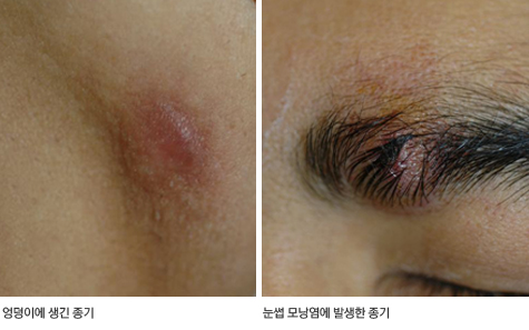 종기 / 종기나는이유 / 종기제거 : 네이버 블로그